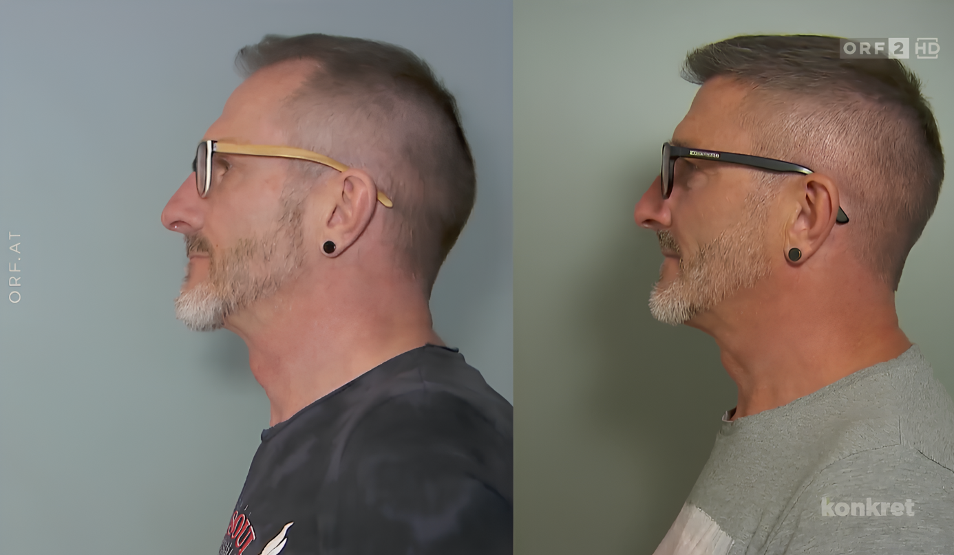 ORF TVthek begleitet Haartransplantation bei Istanbul Vita