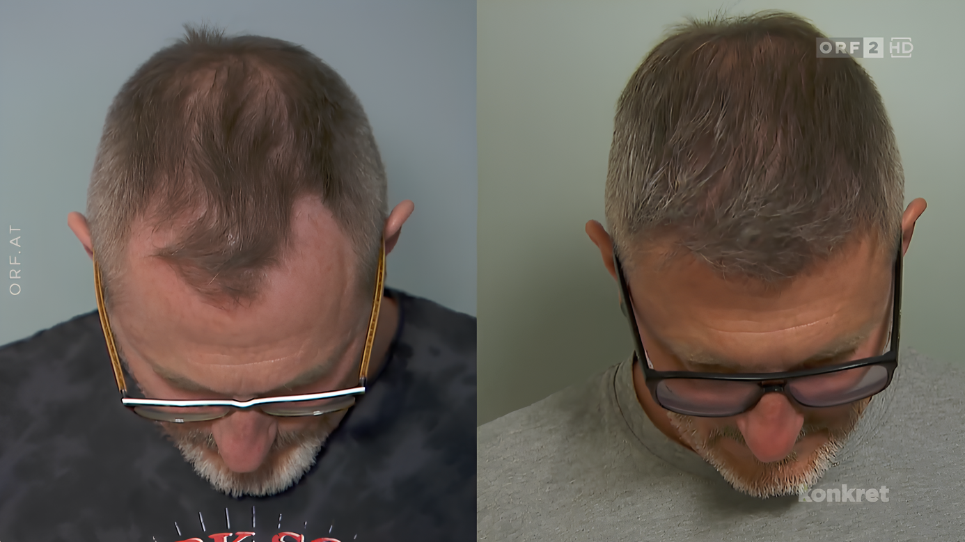 Haartransplantationen